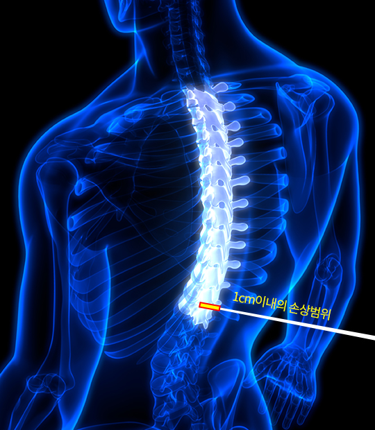 척추내시경(단일공)증상이미지
