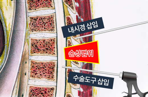 척추내시경(단일공)이미지